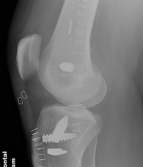 ACL and Posterolateral corner